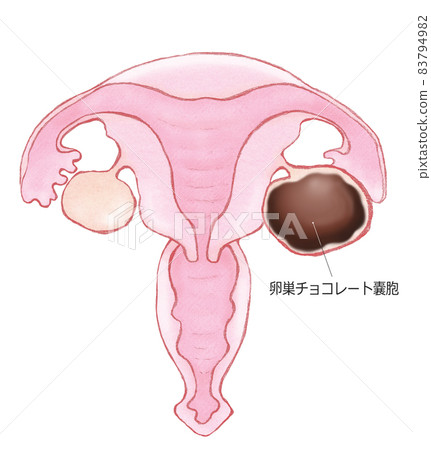 Ovarian chocolate cyst with name 83794982