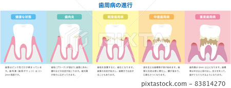 說明牙周病的進展（附說明） 83814270