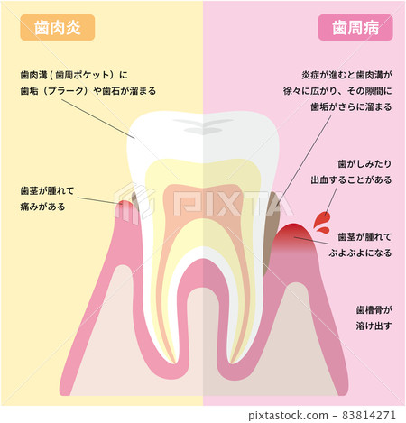 從牙齦炎症到牙周病的進展（附說明） 83814271