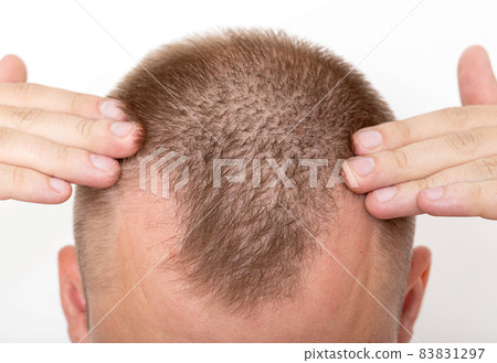 Bald patches on the head of a young man. The concept of the increased hormone dihydrotestosterone. Weakening of hair follicles Bald patches on the head of a young man. The concept of the increased hormone dihydrotestosterone. Weakening of hair follicles 83831297