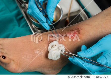 close up doctor cleaning wound on leg, Injuries from falling close up doctor cleaning wound on leg, Injuries from falling 83837074