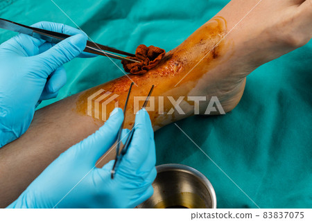 close up doctor cleaning wound on leg, Injuries from falling close up doctor cleaning wound on leg, Injuries from falling 83837075