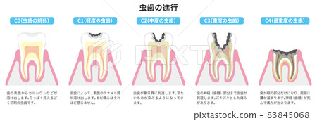 Progression of tooth decay Illustrated 2 83845068