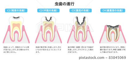 Progression of tooth decay Illustrated 1 83845069