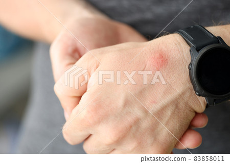 Closeup of red spot on skin of man hand Closeup of red spot on skin of man hand 83858011