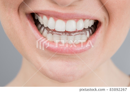 Close-up portrait of a woman putting on a transparent plastic retainer. A girl corrects a bite with the help of an orthodontic device 83892267