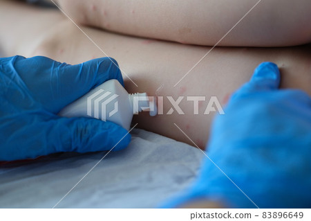 Gloved doctor applies the cream to skin of patient with red itchy inflammations 83896649