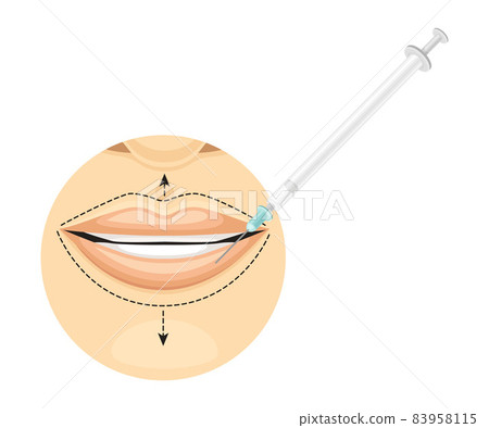 Lip line correction by injections. Cosmetic surgery on female face with dotted lines vector illustration Lip line correction by injections. Cosmetic surgery on female face with dotted lines vector illustration 83958115