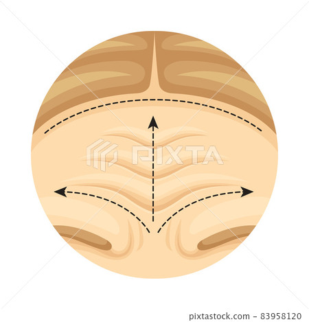 Cosmetic surgery on female forehead with dotted lines. Plastic surgery vector illustration Cosmetic surgery on female forehead with dotted lines. Plastic surgery vector illustration 83958120