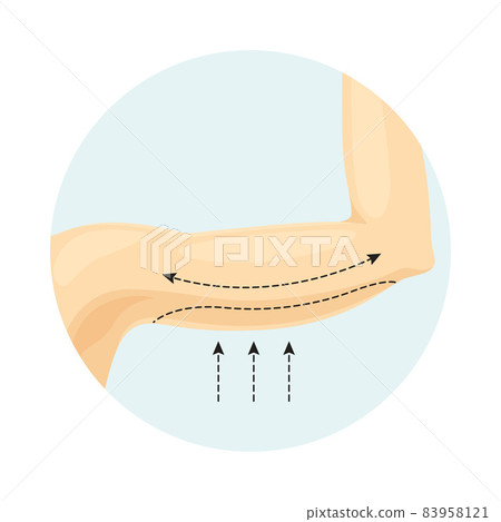 Liposuction of arms. Plastic or cosmetic surgery vector illustration Liposuction of arms. Plastic or cosmetic surgery vector illustration 83958121