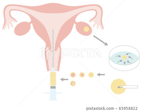 體外受精治療不孕症 83958822