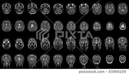 set of serial MRI scans of sixty years old caucasian female head in frontal and horizontal planes 83969209