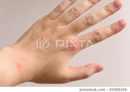 昆蟲叮咬 83998268