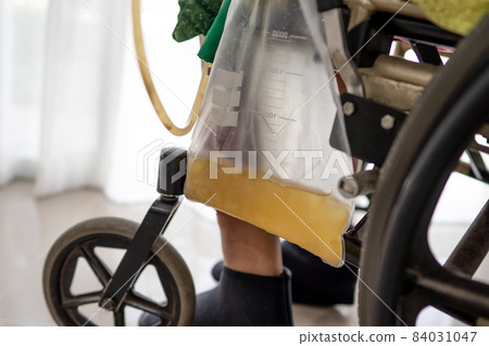 Asian lady woman patient sitting on wheelchair with urine bag in the hospital ward, healthy medical concept 84031047