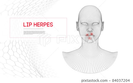 Herpes on lips . Woman herpes on face with treatment cold on the lips. 84037204