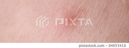 White pus pimple on skin of face closeup 84053418
