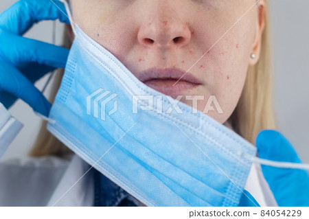 Doctor removes the protective mask and shows irritation on face skin. Antiviral measures. Means of protection against covid 19. Long wearing of a mask. Acne on face and chafing. Dry lips and red dots Doctor removes the protective mask and shows irritation on face skin. Antiviral measures. Means of protection against covid 19. Long wearing of a mask. Acne on face and chafing. Dry lips and red dots 84054229