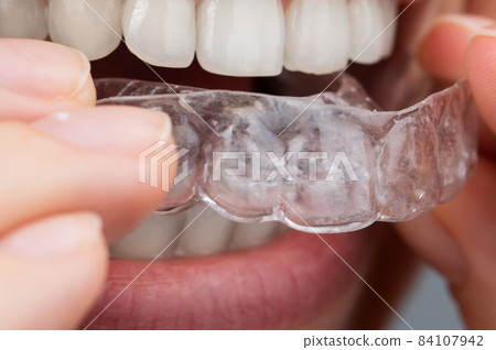 Caucasian woman putting on aligners. Orthodontic teeth straightening device. Caucasian woman putting on aligners. Orthodontic teeth straightening device. 84107942
