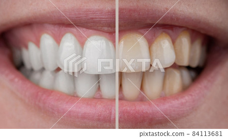 Close-up of a woman's smile before and after teeth whitening. 84113681