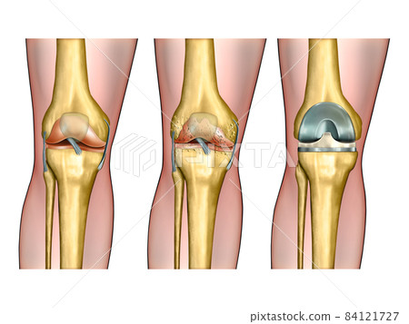 Knee replacement Knee replacement 84121727