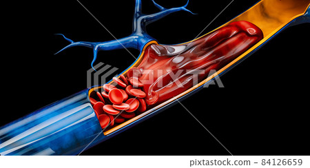 3d Illustration of Deep Vein Thrombosis or Blood Clots. Embolism, clipping path included. 84126659