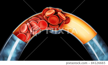 3d Illustration of Deep Vein Thrombosis or Blood Clots. Embolism, clipping path included 84126665