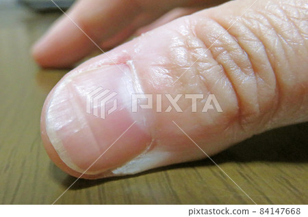 Onycholysis lateral groove 84147668