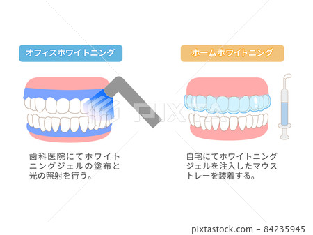 Illustration of the difference between home whitening and office whitening 84235945