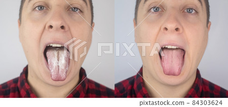 Before and after. White curd on the tongue. A physician or gastroenterologist examines a man tongue. Patient has poor oral hygiene or a symptom of illness. Symptoms of a latent disease. Before and after. White curd on the tongue. A physician or gastroenterologist examines a man tongue. Patient has poor oral hygiene or a symptom of illness. Symptoms of a latent disease. 84303624