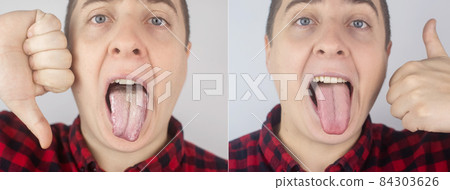 Before and after. White curd on the tongue. A physician or gastroenterologist examines a man tongue. Patient has poor oral hygiene or a symptom of illness. Symptoms of a latent disease. Before and after. White curd on the tongue. A physician or gastroenterologist examines a man tongue. Patient has poor oral hygiene or a symptom of illness. Symptoms of a latent disease. 84303626