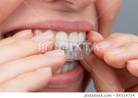 Caucasian woman putting on aligners. Orthodontic teeth straightening device. 84314734