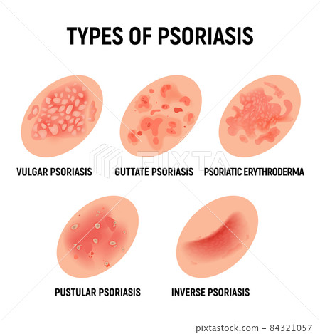 Psoriasis rash vector skin hand infection background. Psoriasis dermatitis eczema cartoon 84321057