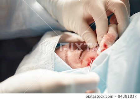 Close up of the face of a patient who is undergoing blepharoplasty. The surgeon cuts the eyelid and performs manipulations using medical instruments 84381837