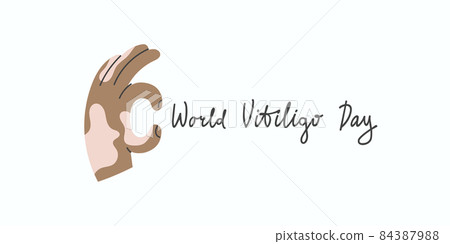 Hand with vitiligo makes ok gesture. Card of world vitiligo day. Hand with vitiligo makes ok gesture. Card of world vitiligo day. 84387988
