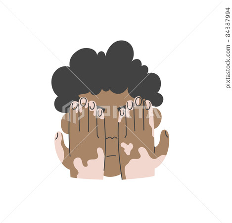 The guy with vitiligo bashfully hides behind his hands The guy with vitiligo bashfully hides behind his hands 84387994