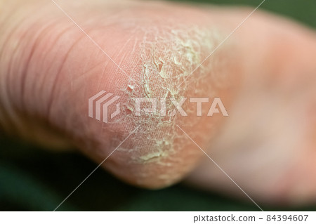 鞋跟裂縫 84394607