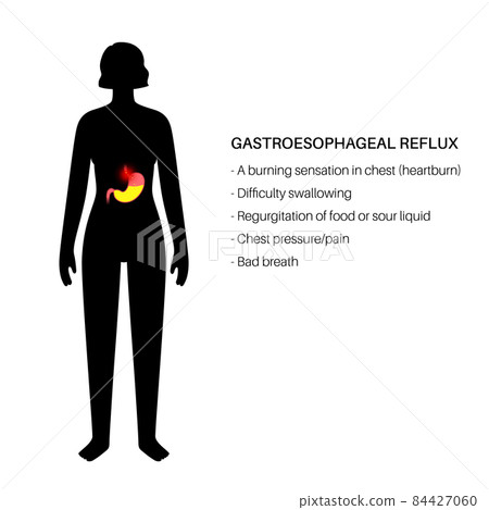 Gastroesophageal reflux disease Gastroesophageal reflux disease 84427060