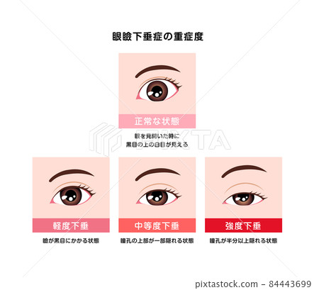 Severity comparison vector illustration of ptosis Severity comparison vector illustration of ptosis 84443699