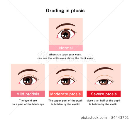 Severity comparison vector illustration of ptosis 84443701