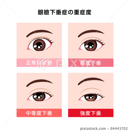 上瞼下垂的嚴重程度比較矢量圖 上瞼下垂的嚴重程度比較矢量圖 84443702