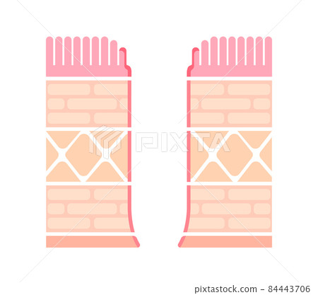 Cross-section illustration of stomach wall / Severe gastric ulcer (perforation) (no text) Cross-section illustration of stomach wall / Severe gastric ulcer (perforation) (no text) 84443706