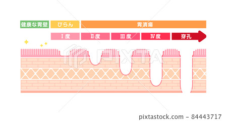 胃壁橫截面圖/胃潰瘍的症狀和嚴重程度 84443717