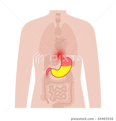 Gastroesophageal reflux disease 84465938