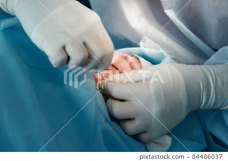 Close up of the face of a patient who is undergoing blepharoplasty. The surgeon cuts the eyelid and performs manipulations using medical instruments 84486037