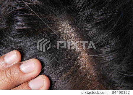 men with dandruff in his hair, closeup men with dandruff in his hair, closeup 84490332