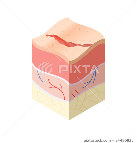 Skincare medical concept. Problems in cross-section of human skin horizontal layers structure. Anatomy illustrative model Skincare medical concept. Problems in cross-section of human skin horizontal layers structure. Anatomy illustrative model 84490923
