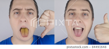 Before and after. Man has a yellow tongue. Painful yellow coating on mucous membrane of the tongue. Diseases of the gastrointestinal tract, liver and gallbladder. Consequences of taking antibiotics. Before and after. Man has a yellow tongue. Painful yellow coating on mucous membrane of the tongue. Diseases of the gastrointestinal tract, liver and gallbladder. Consequences of taking antibiotics. 84491648