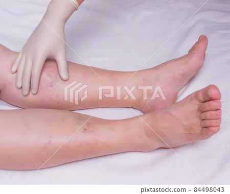 Doctor examines the patient's legs for the presence and degree of varicose veins in the legs, close-up, white background, phlebeurysm woman, hand 84498043