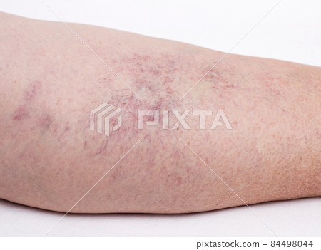 Vascular marks on the skin from varicose veins, vascular pattern on the skin, close-up, phlebeurysm, problem, white background 84498044