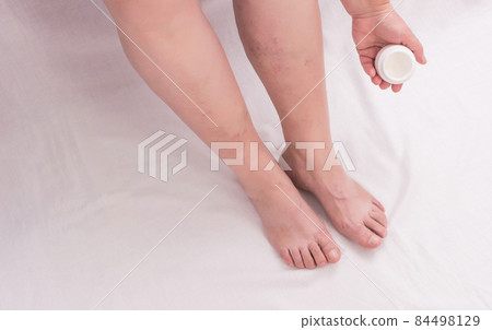 An elderly woman applies healing ointment to her leg on varicose veins, phlebeurysm legs, woman, white background, skincare, copy space An elderly woman applies healing ointment to her leg on varicose veins, phlebeurysm legs, woman, white background, skincare, copy space 84498129